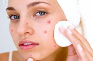 Qué es el acné y como nos afecta