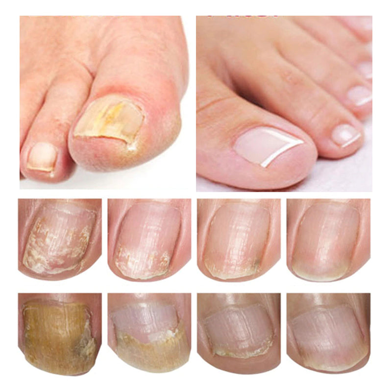 Tratamiento para el cuidado de la piel Hierba Reparación de uñas Esencia
