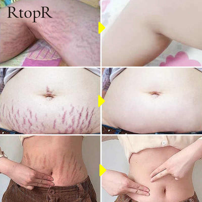 Remove pregnancy scars cream mango rtopr