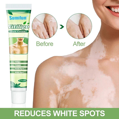 Crema para manchas de vitiligo
