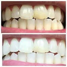 Blanqueamiento dental AP 24